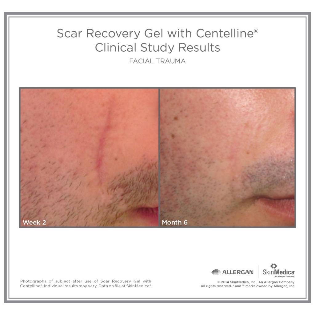 Scar Recovery Gel Scar Recovery Gel with Centelline